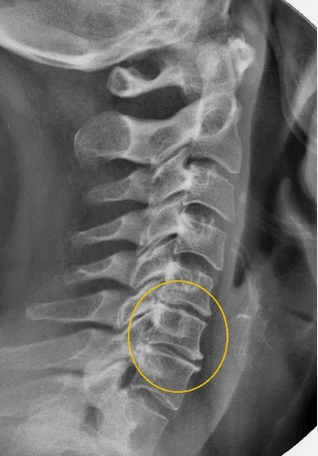 A méhnyak gerincének osteochondrosis egy x -seriségen